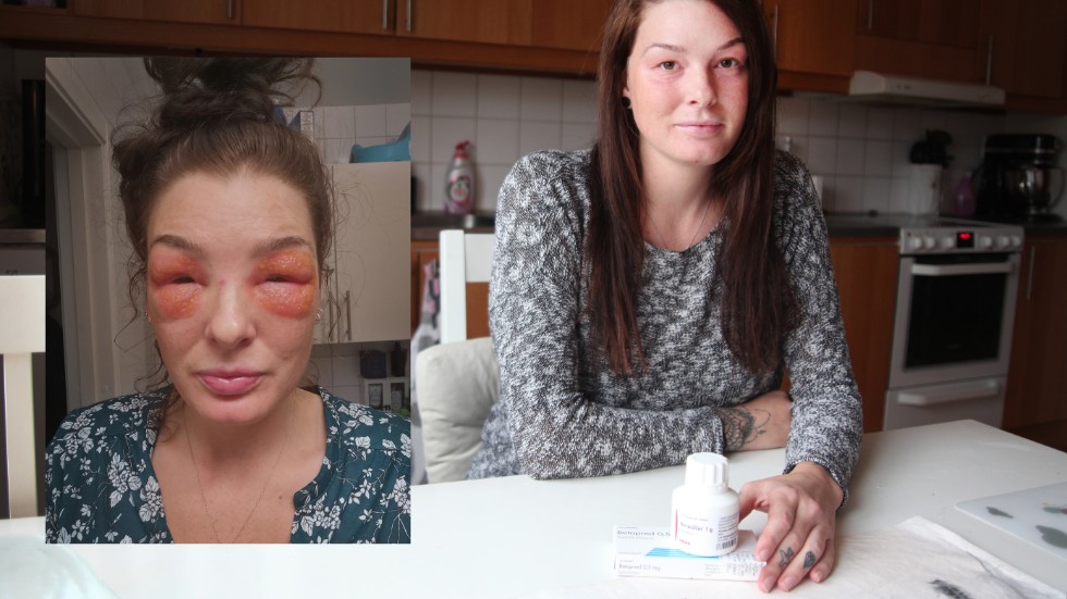 Kim Eriksson, 31, tvingades äta kortison och penicillin i nio dagar, för att häva den allergiska reaktionen och dämpa infektionen kring ögonen. Huden är långt ifrån färdigläkt.