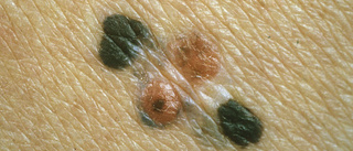 Fler fall av farlig hudcancer  