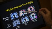 Alzheimer kan upptäckas innan symtomen märks