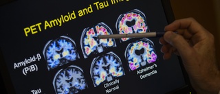 Alzheimer kan upptäckas innan symtomen märks