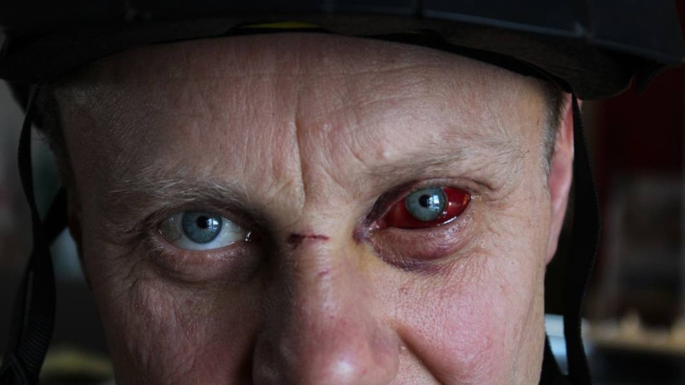 Ett öga rött. Gunnar Gustafsson är blåslagen och har ett par frakturer efter olyckan i fredags.