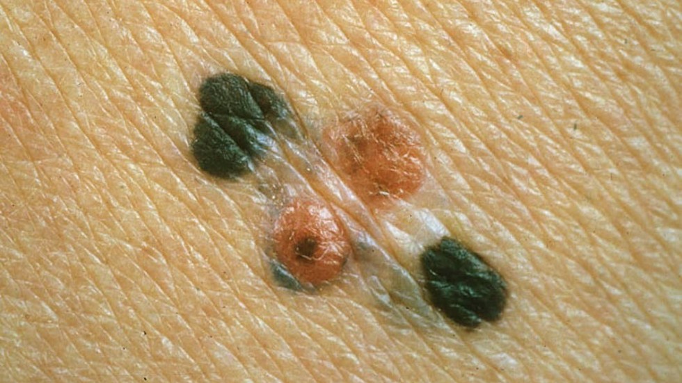 Hudförändringar kan vara ett tecken på malignt melanom, den vanligaste typen av hudcancer.