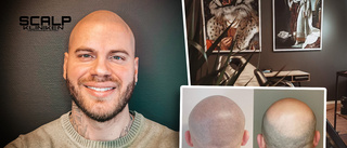 Billy gör succé med ny typ av behandling vid håravfall: "Vänder hela självkänslan"