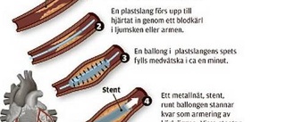 Stent i kranskärl ger skydd mot återfall