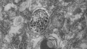 Smarta nanopartiklar kan angripa lungtumörer
