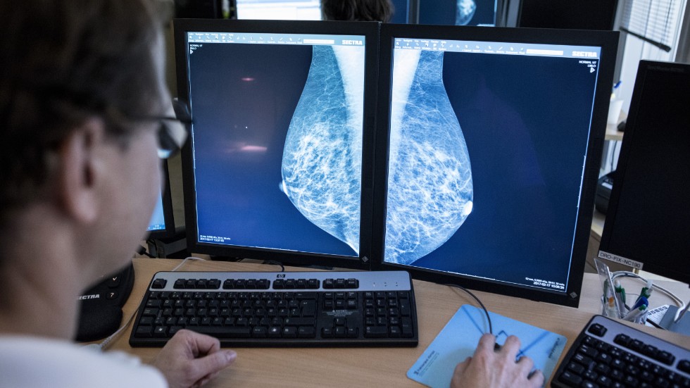 Screening som bland annat mammografi har bidragit till att fler fall av cancer upptäcks och behandlas. Arkivbild.