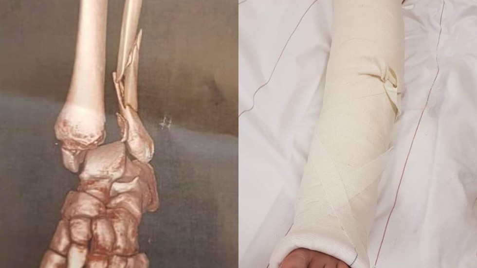 Röntgenbilderna visade fem frakturer i benet och två frakturer i foten. Gipset ska sitta på i sex veckor.
