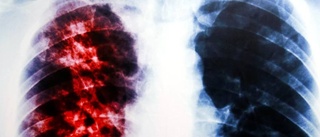 Hade tuberkulos – vården missade