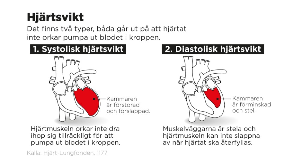 Det finns två typer av hjärtsvikt. I både fallen handlar det om att hjärtatinte orkar pumpa ut blodet i kroppen.