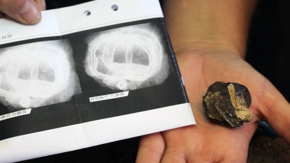 Benbit som sitter ihop med ett spänne, visar röntgen.