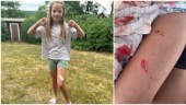 Mathilda, 7 år, blev biten när hon badade – fick sy fem stygn