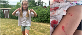 Mathilda, 7 år, blev biten av gädda – fick sy fem stygn: "Sjukt"