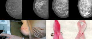 ”Täta bröst” • Så många kvinnor har det på Gotland • Därför ökar det risken för cancer