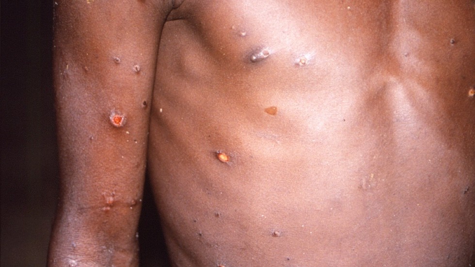 Hudutslag är det vanligaste symtomet på både apkoppor och smittkoppor. Arkivbild.