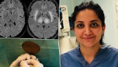 Covid kan ge hjärnskada – forskare: ”Angriper hjärnan”