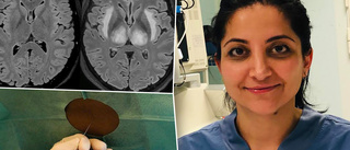 Covid kan ge hjärnskada – forskare: ”Angriper hjärnan”