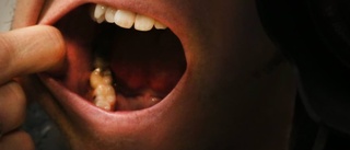 Patient fick fel tand rotfylld