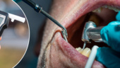 Tandläkare körde grovt rattfull fem gånger – miste legitimationen