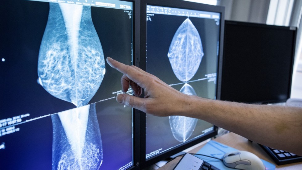 Mammografi upptäcker två av tre cancertumörer.