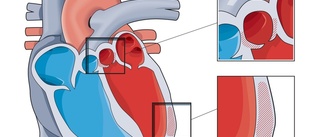 Debatt: Bättre vård kan hjälpa Sörmlands 7 000 hjärtsviktssjuka