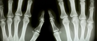 Röntgen anses försvåra för artrospatienter